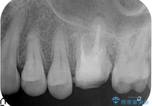放置した虫歯 精密な治療の希望の治療中