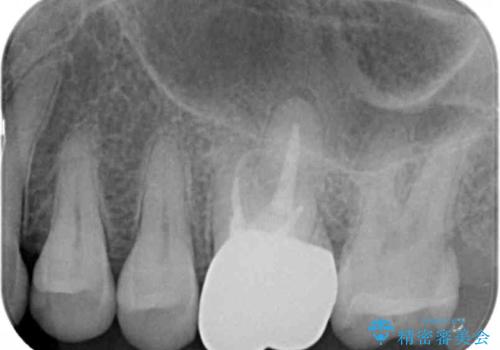 放置した虫歯 精密な治療の希望の治療後