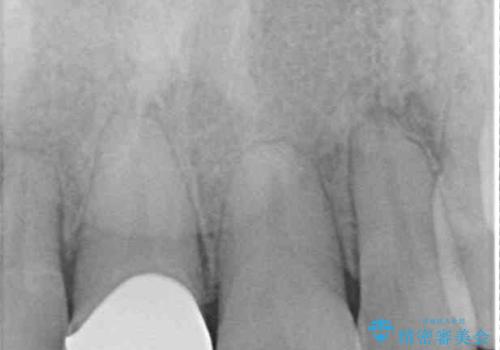 前歯が折れたついでに歯並びも改善　矯正治療と前歯のセラミック治療の治療後