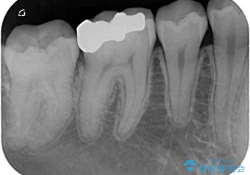 目立つ銀歯を白くしたい セラミック治療の治療前