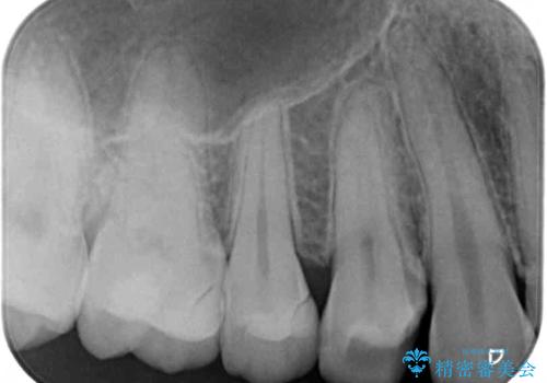 詰め物が外れた セラミックインレー修復の治療前