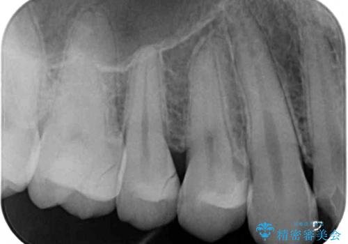 詰め物が外れた セラミックインレー修復の治療後