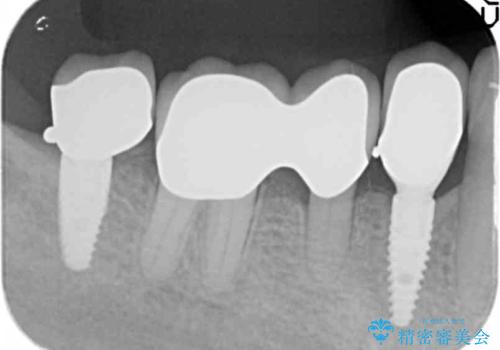 [ 臼歯部インプラント治療 ]   抜けた歯を治療したい