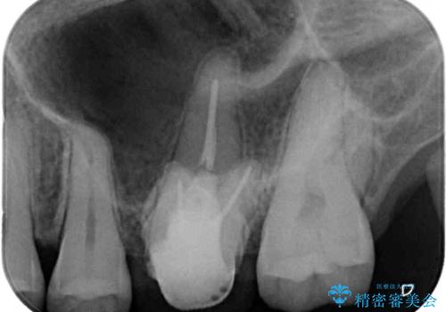 目立つ銀歯を白くしたい セラミック治療の治療中