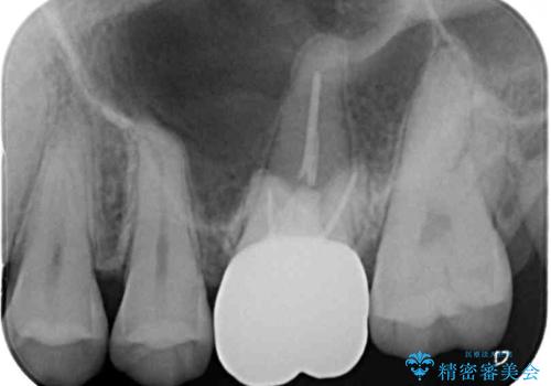 目立つ銀歯を白くしたい セラミック治療の治療後