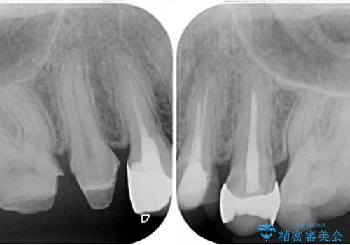 治療中放置してしまった奥歯 セラミック治療の治療前