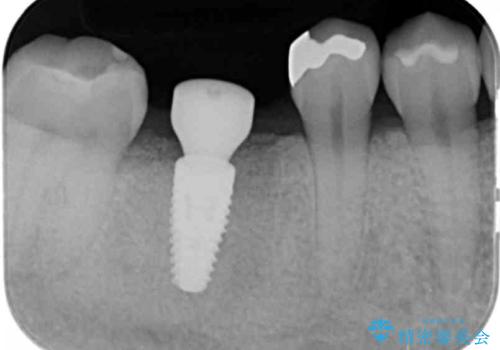 放置した虫歯　インプラントによる機能回復の治療中