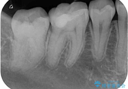 目立つ銀歯を白くしたい セラミック治療の治療後