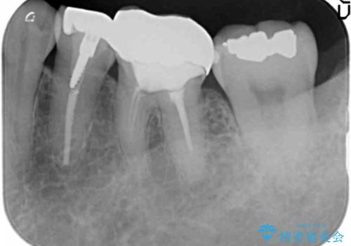 下の銀歯をセラミックに 虫歯治療の治療前