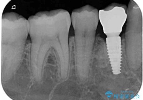 欠損歯列の矯正治療とインプラント治療の治療後