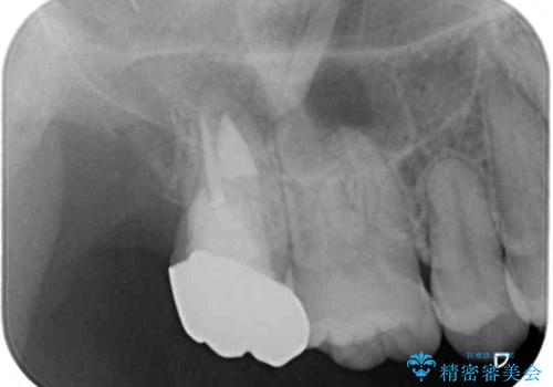 不快感が続く奥歯 外科処置を併用したセラミック補綴治療の治療後