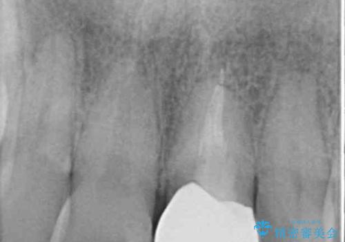欠損歯列の矯正治療とインプラント治療の治療後