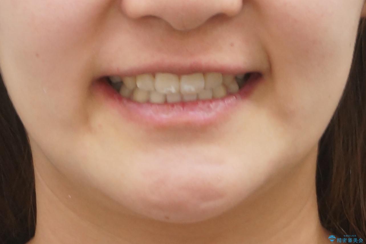 真ん中が右にずれている 前歯のがたつき 治療途中に地方へ引っ越したが、通ってワイヤー矯正の治療後(顔貌)