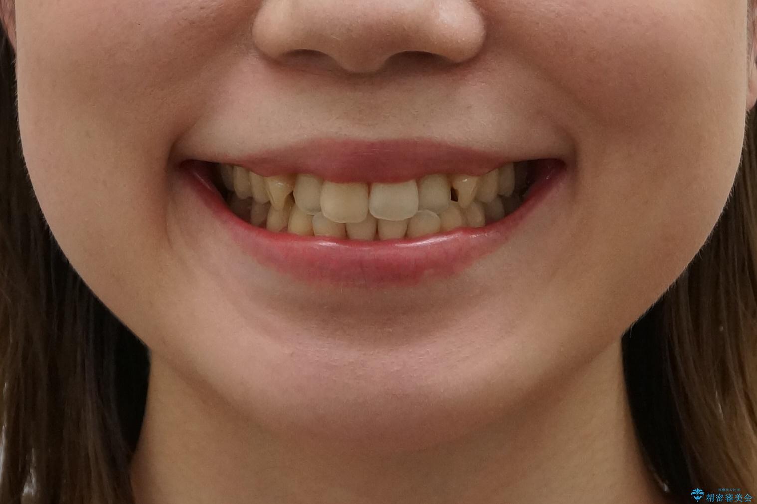 犬歯のねじれ　上の歯が引っ込んでいるの治療前（顔貌）