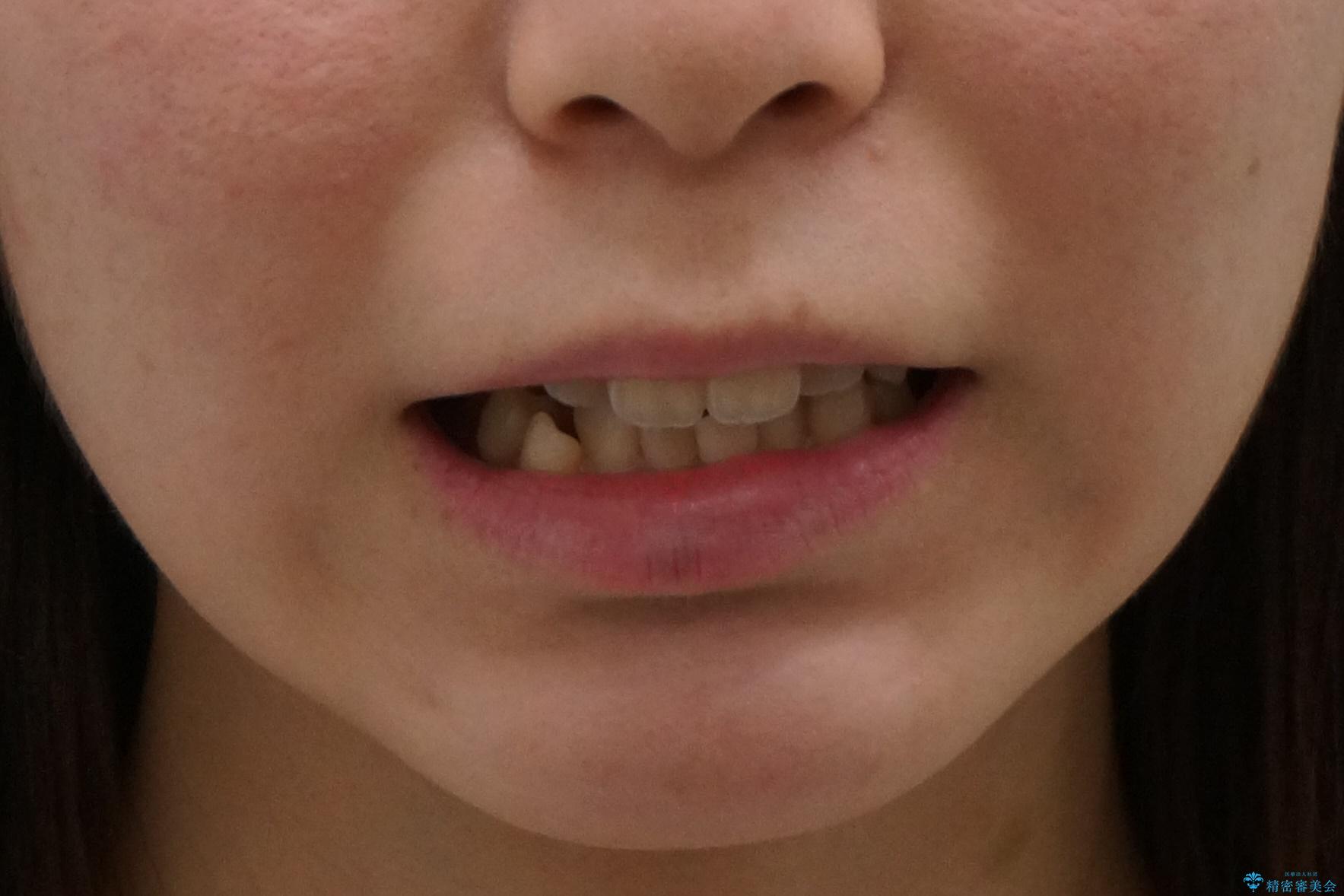 下の八重歯　歯を抜かずに　インビザライン治療の治療前（顔貌）