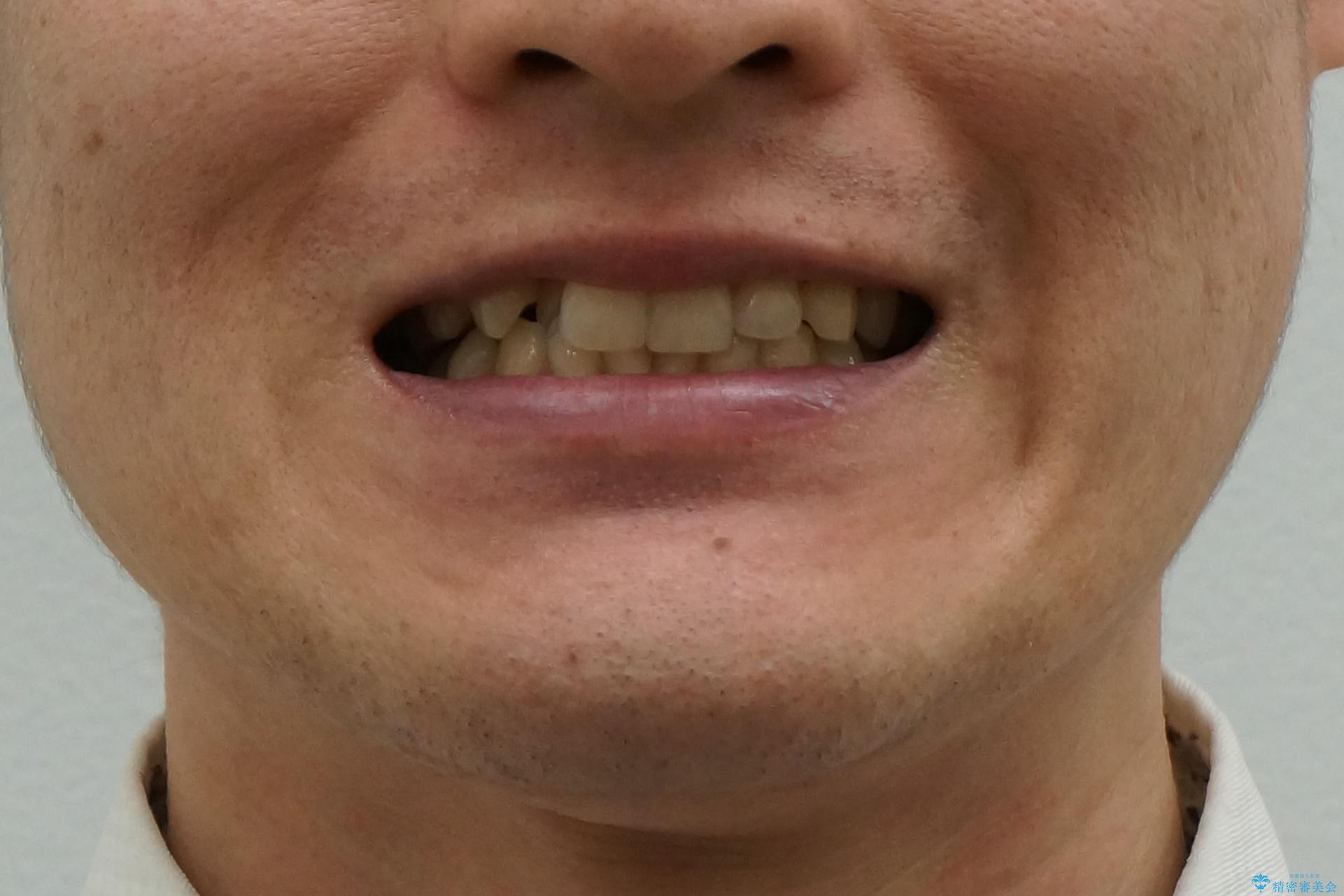 引っ込んだ前歯を並べる　歯を抜かないマウスピース矯正の治療前（顔貌）