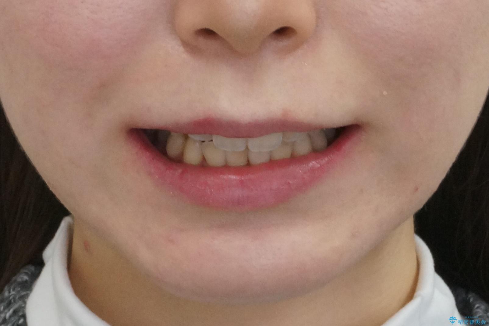 下の八重歯　歯を抜かずに　インビザライン治療の治療後（顔貌）