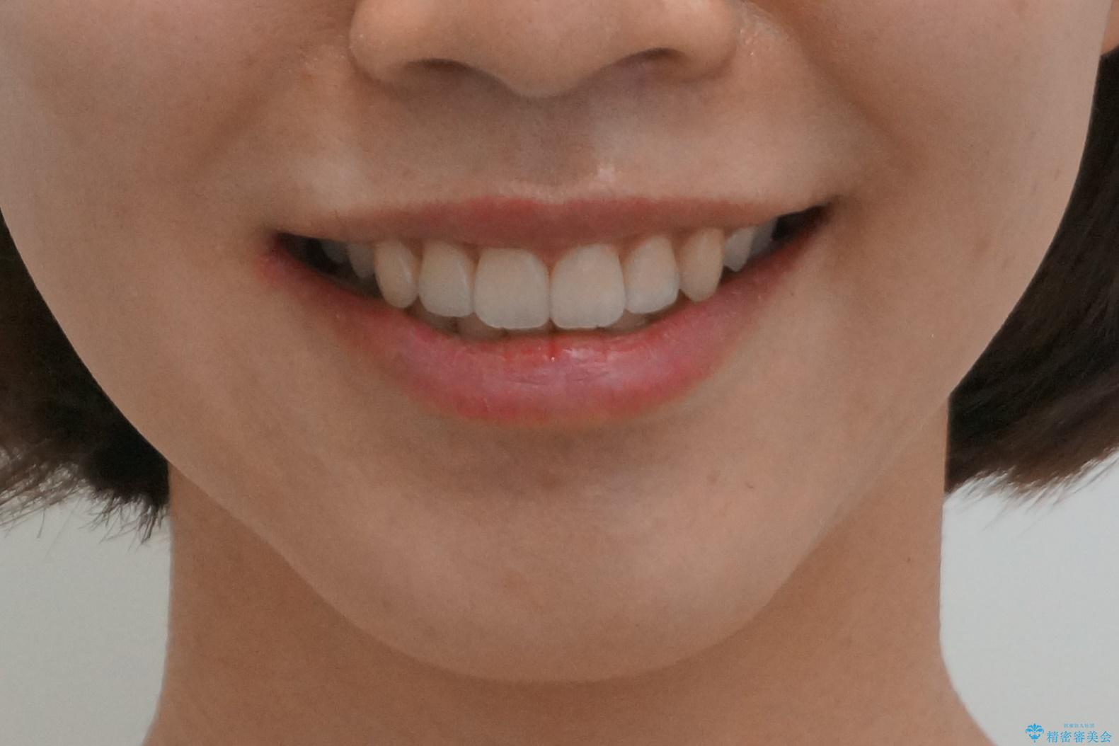 再矯正　昔ワイヤーで治療　前歯の並びを再度きれいにの治療後（顔貌）