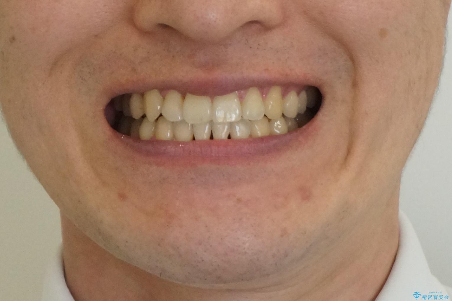 引っ込んだ前歯を並べる　歯を抜かないマウスピース矯正の治療後（顔貌）
