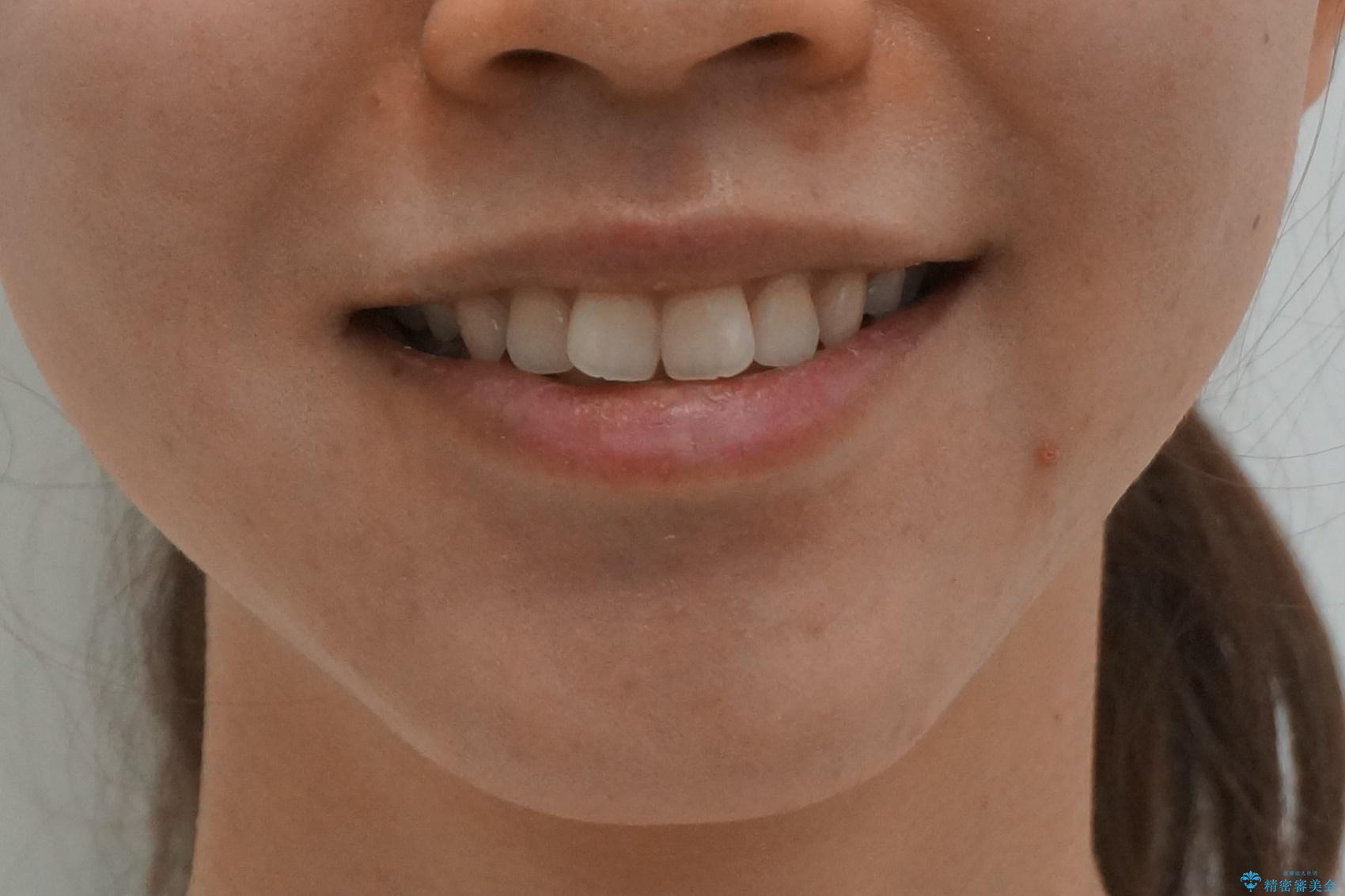 再矯正 昔ワイヤーで治療 前歯の並びを再度きれいにの治療前(顔貌)