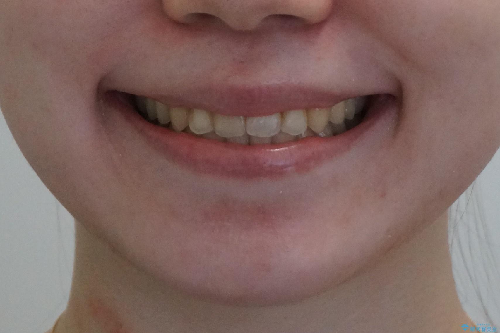 犬歯のねじれ　上の歯が引っ込んでいるの治療後（顔貌）