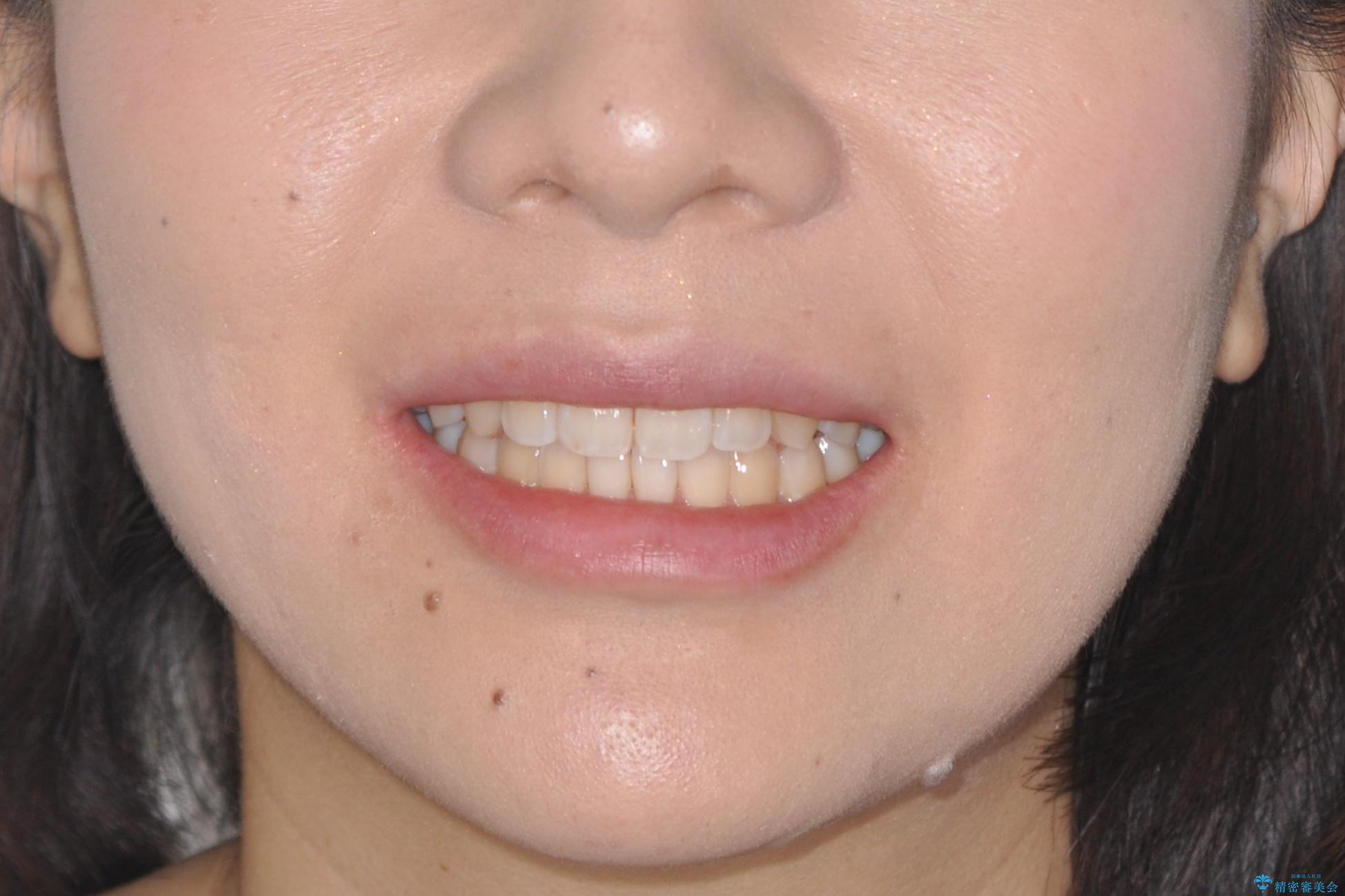 インビザラインによる再矯正症例の治療後(顔貌)