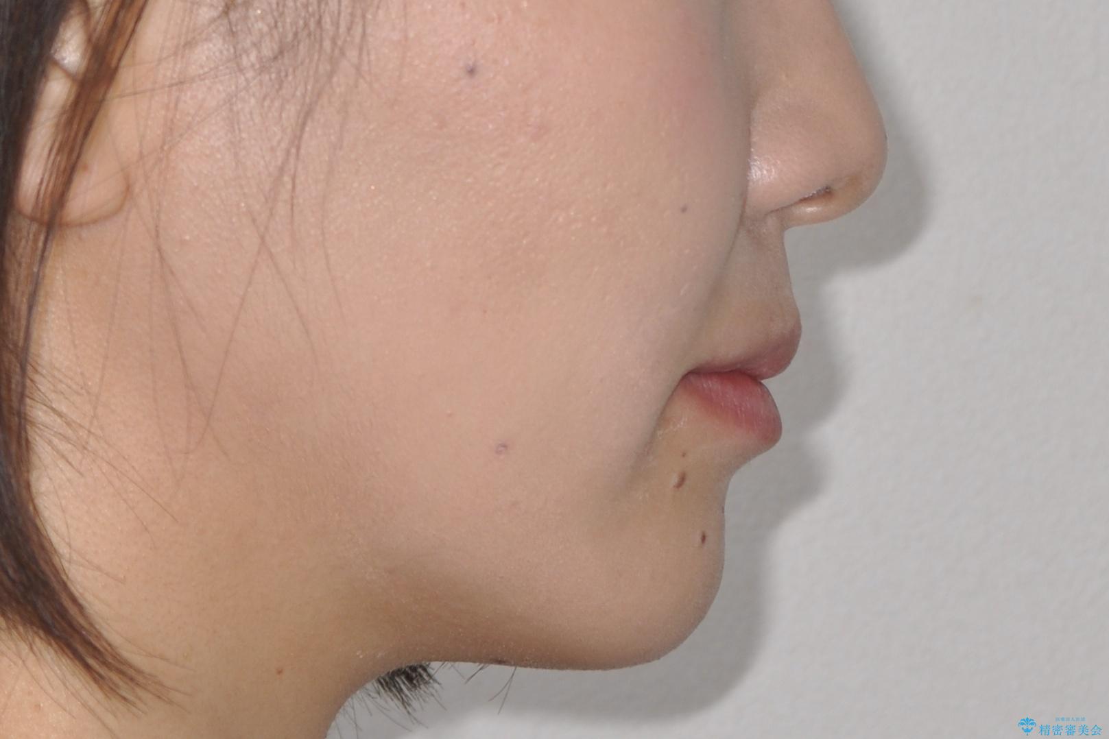 インビザラインによる再矯正症例の治療後(顔貌)