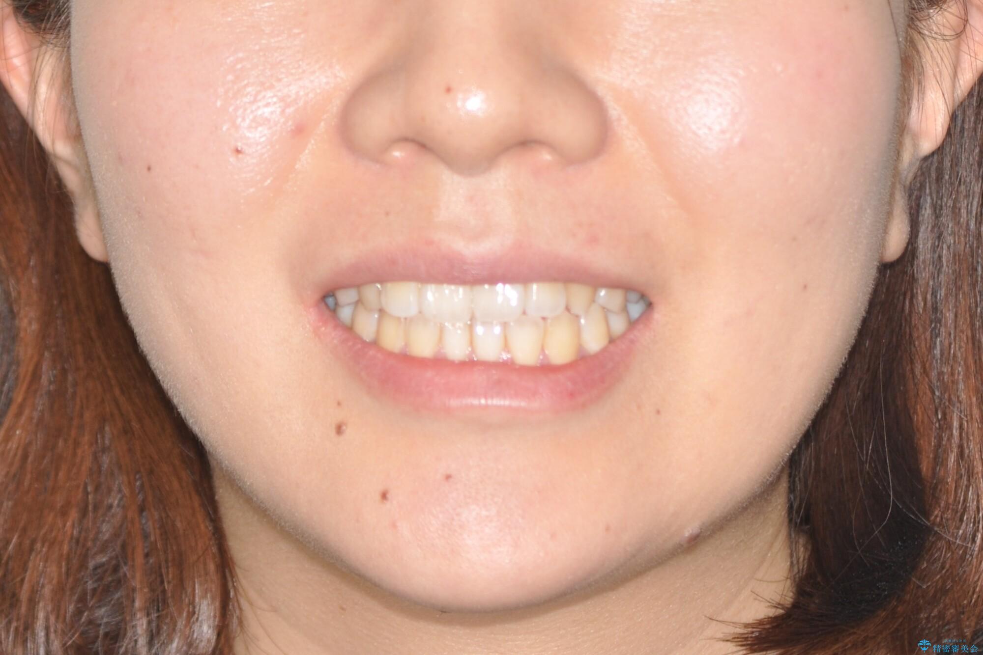 インビザラインによる再矯正症例の治療前(顔貌)