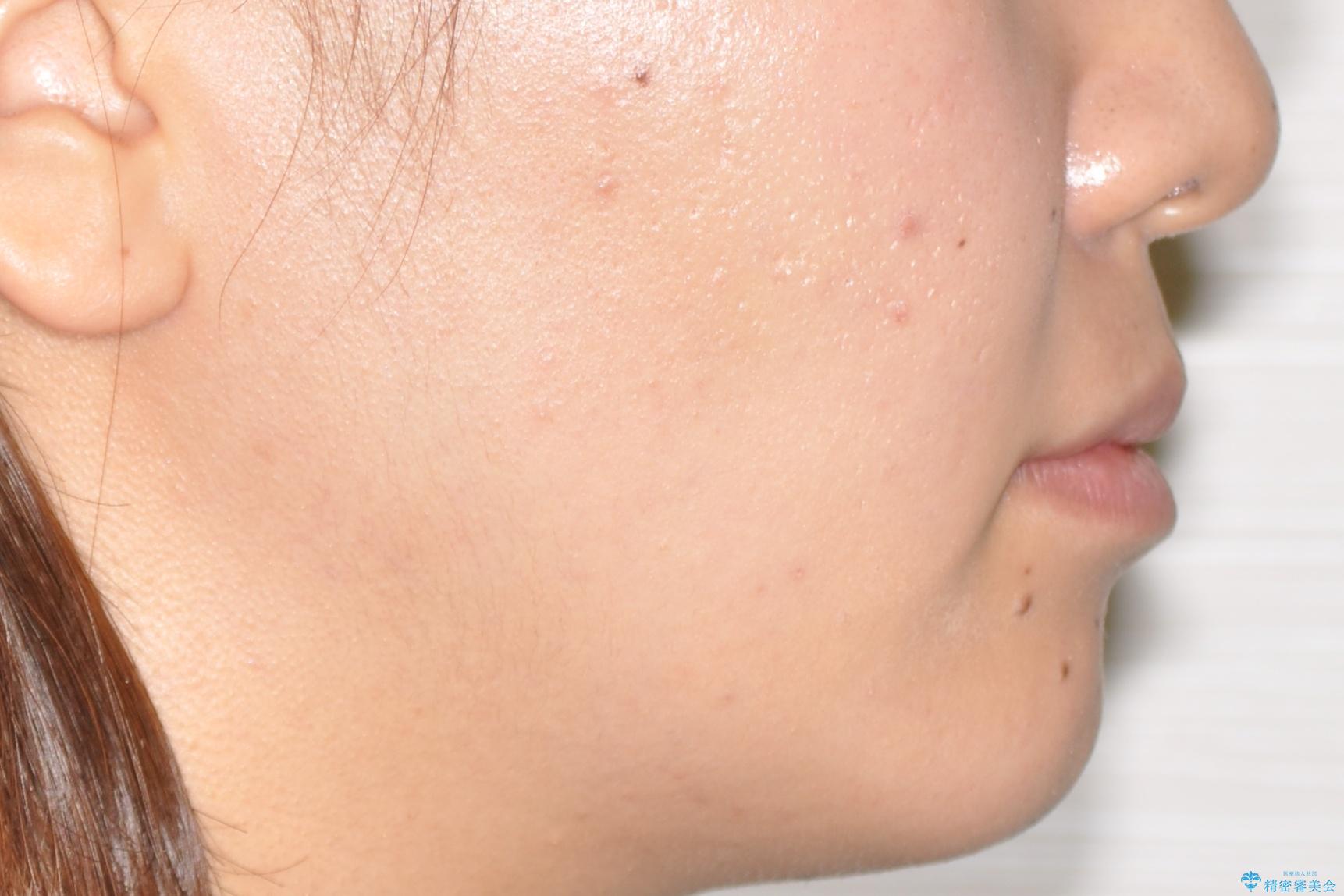 インビザラインによる再矯正症例の治療前(顔貌)