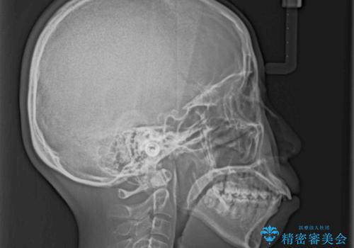 口がしっかりと閉じられない ワイヤー装置での抜歯矯正で出っ歯を改善の治療前