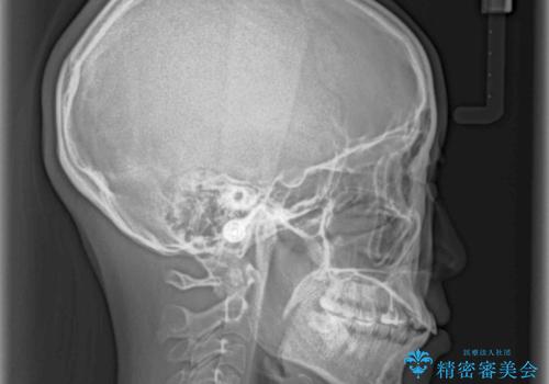 【モニター】気になる八重歯を素早く改善 ワイヤー装置での抜歯矯正の治療前