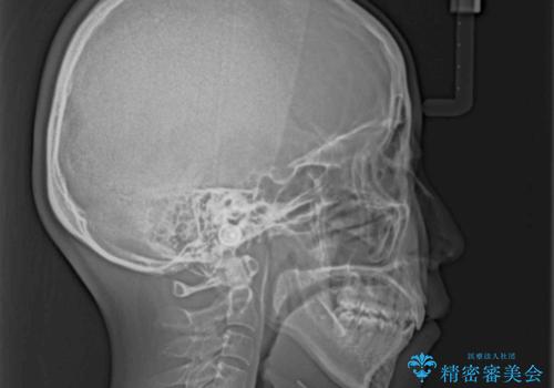 口がしっかりと閉じられない ワイヤー装置での抜歯矯正で出っ歯を改善の治療後