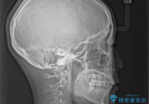 【モニター】気になる八重歯を素早く改善 ワイヤー装置での抜歯矯正の治療後