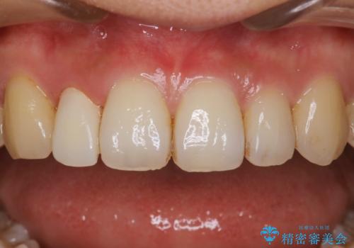 ステイン除去で歯を白くの症例 治療前