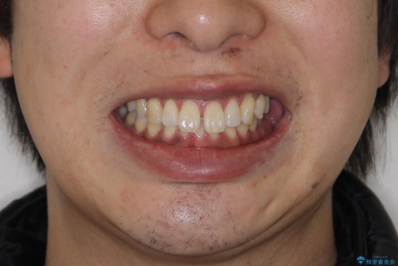 『前歯のすき間を短期間で治したい』インビザライン(枚数制限あり)症例の治療前（顔貌）