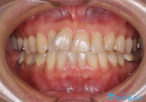 インビザラインは面倒くさい 目立たないワイヤー装置による矯正治療の症例 治療前