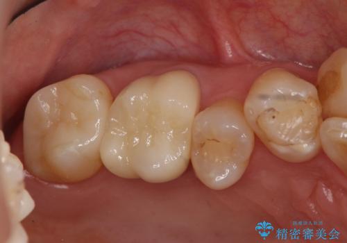 奥歯の銀歯、プラスチックのやりかえの症例 治療後