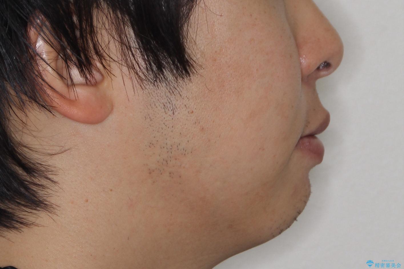 『前歯のすき間を短期間で治したい』インビザライン(枚数制限あり)症例の治療前(顔貌)