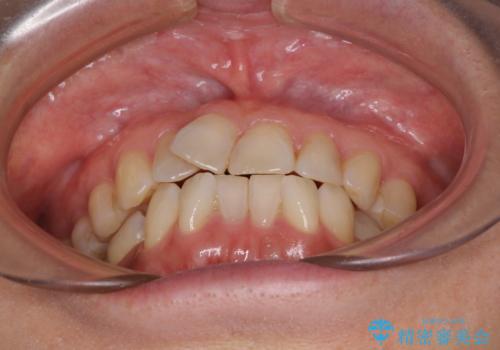 インビザラインは面倒くさい 目立たないワイヤー装置による矯正治療の治療前