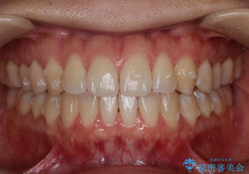インビザラインによる再矯正症例の治療中
