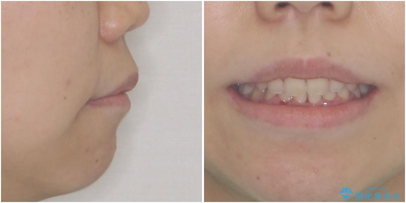 口がしっかりと閉じられない　ワイヤー装置での抜歯矯正で出っ歯を改善の治療後（顔貌）