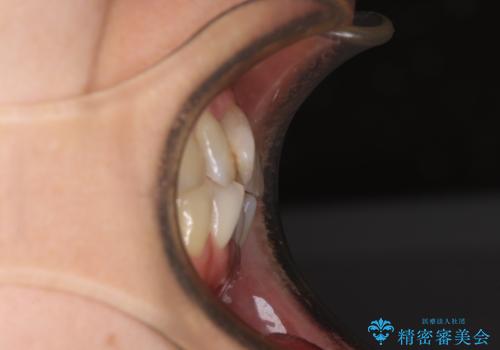 インビザラインは面倒くさい 目立たないワイヤー装置による矯正治療の治療前