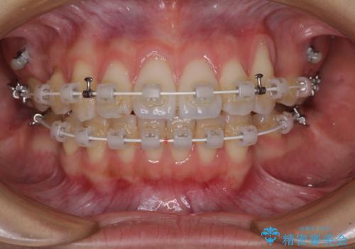 【モニター】気になる八重歯を素早く改善 ワイヤー装置での抜歯矯正の治療中