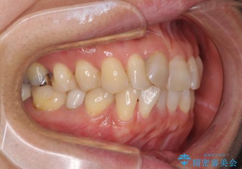 インビザラインは面倒くさい 目立たないワイヤー装置による矯正治療の治療前