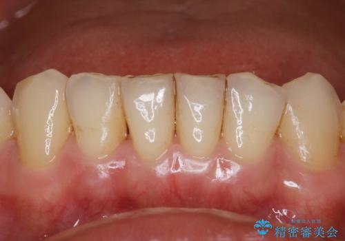 ステイン除去で歯を白くの治療前