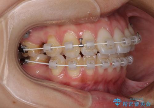 【モニター】気になる八重歯を素早く改善　ワイヤー装置での抜歯矯正の治療中