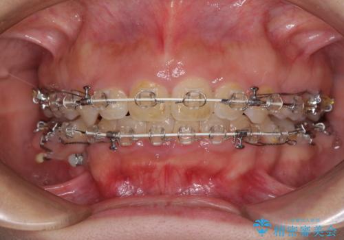 口がしっかりと閉じられない　ワイヤー装置での抜歯矯正で出っ歯を改善の治療中