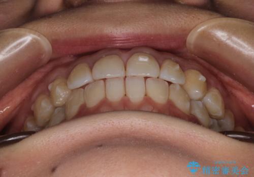 インビザラインによる再矯正症例の治療中