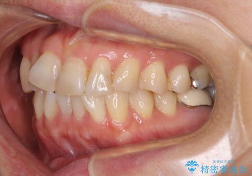 インビザラインは面倒くさい 目立たないワイヤー装置による矯正治療の治療前