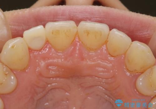 ステイン除去で歯を白くの治療前
